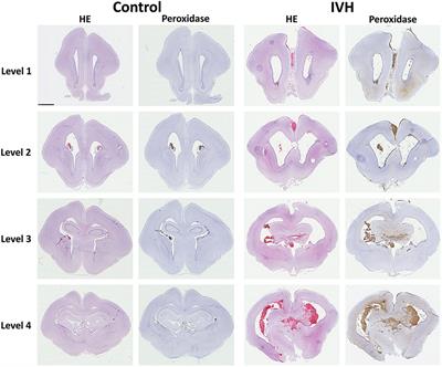 High Presence of Extracellular Hemoglobin in the Periventricular White Matter Following Preterm Intraventricular Hemorrhage